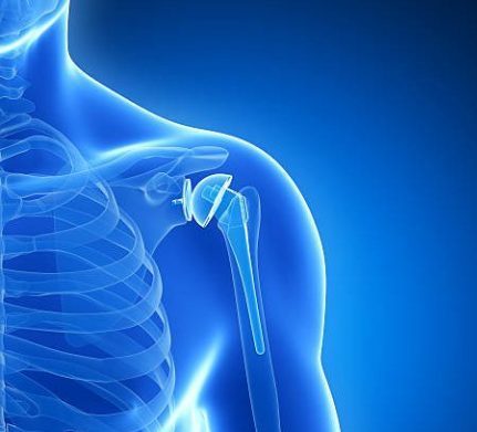 3d rendered illustration of a shoulder replacement