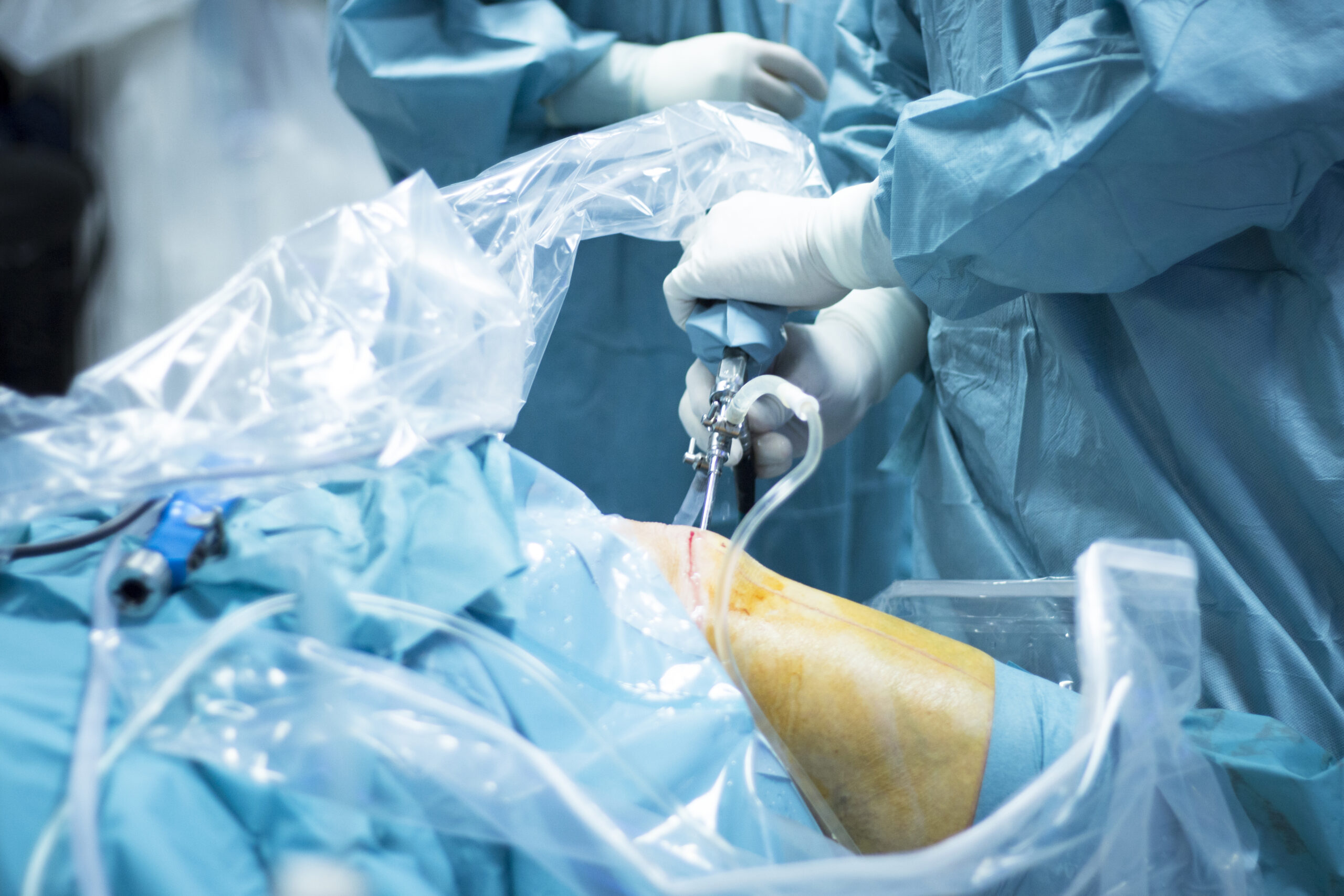 Knee arthroscopy orthopedic surgery operation
